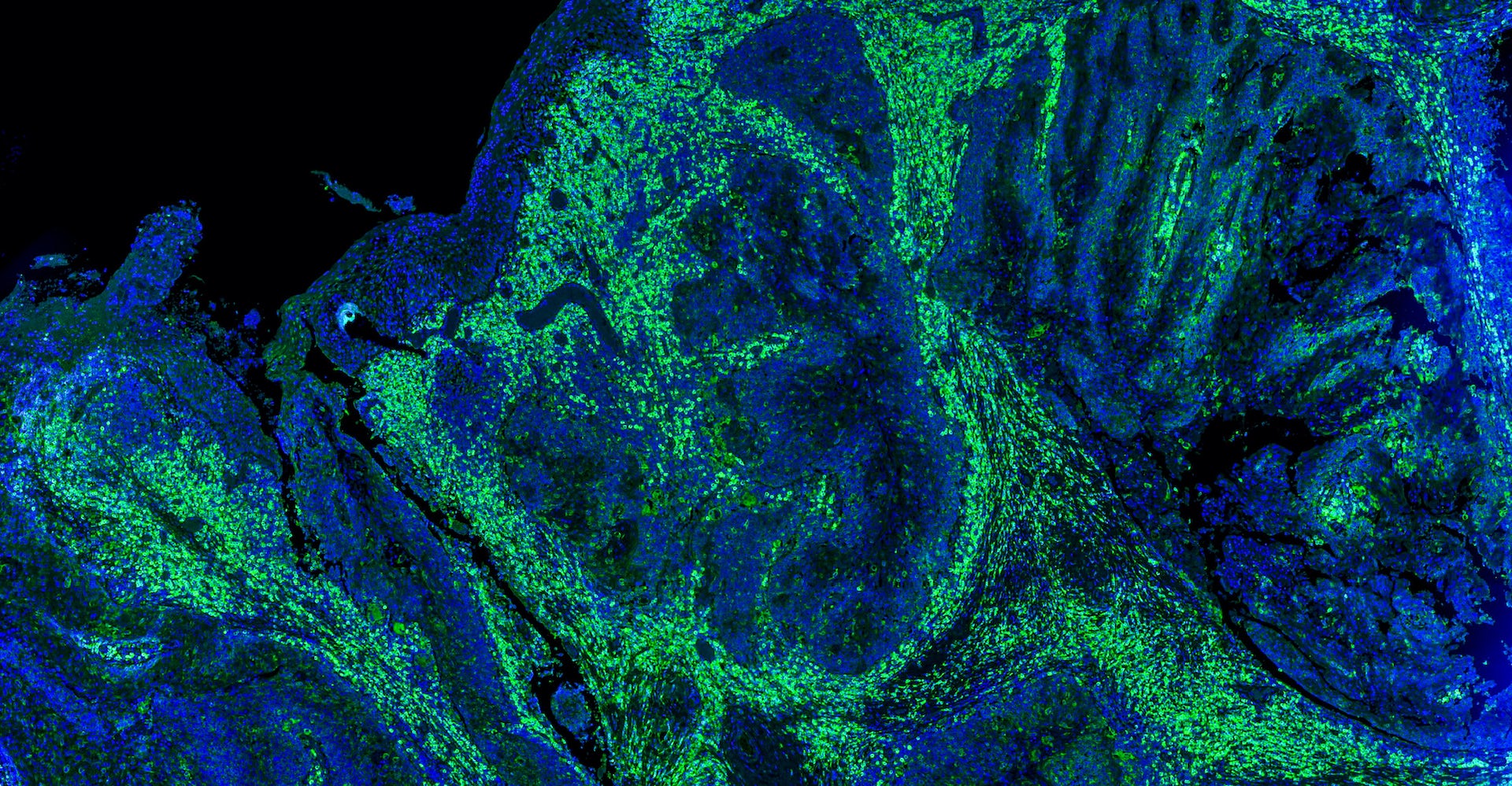 Tinción fluorescente de células cancerosas